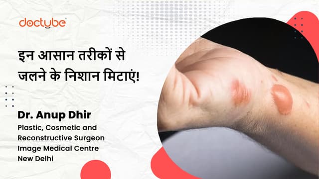 इन आसान तरीकों से जलने के निशान मिटाएं!